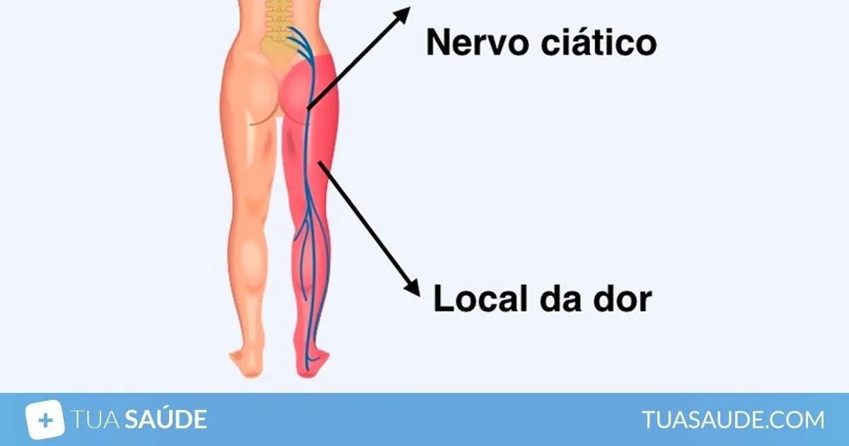 Extensão do nervo ciático