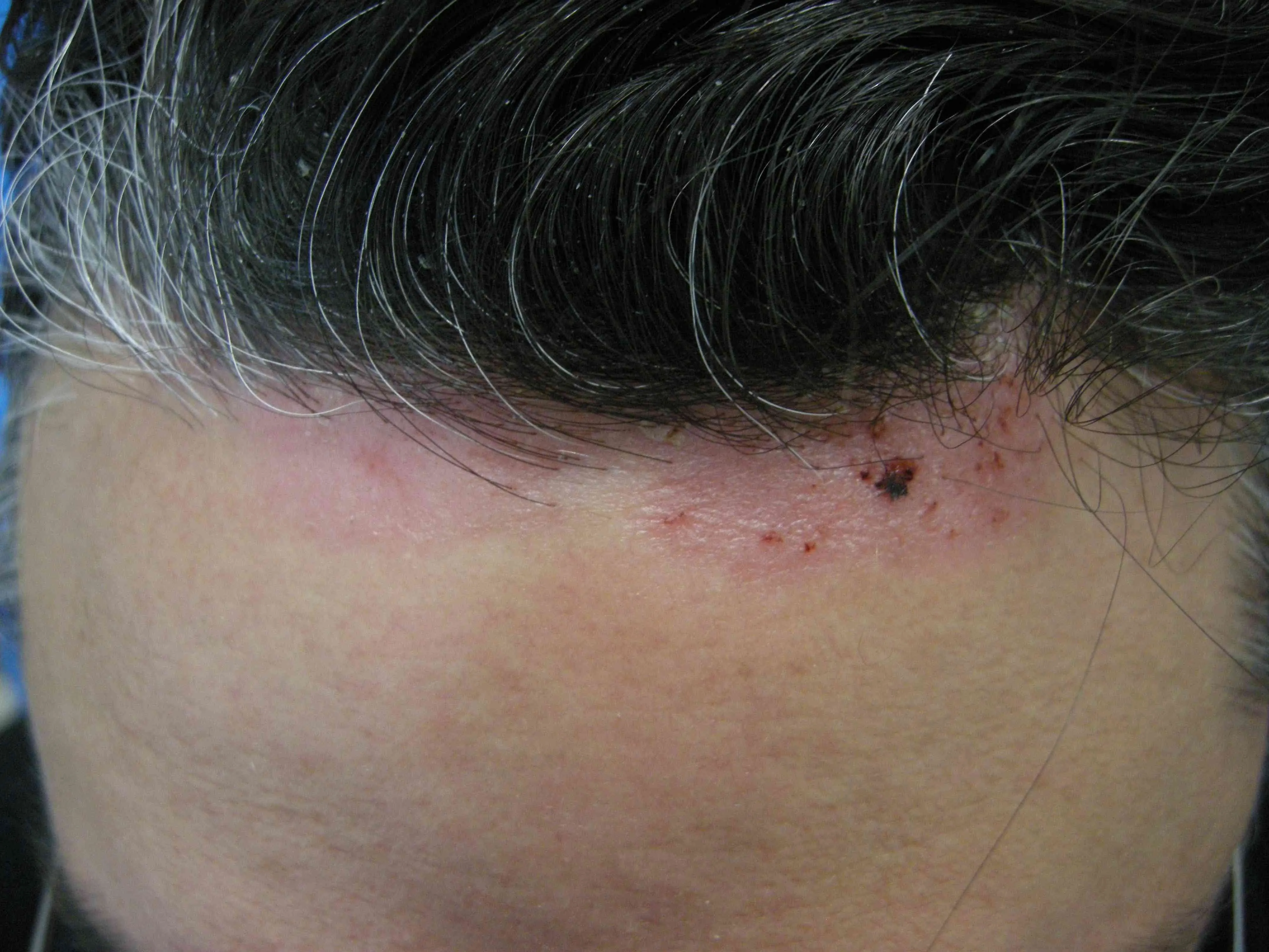 Psoríase facial