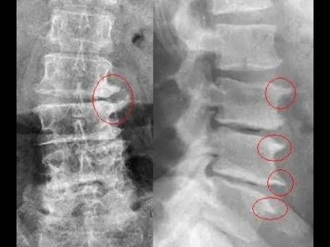 Radiografia de um bico de papagaio