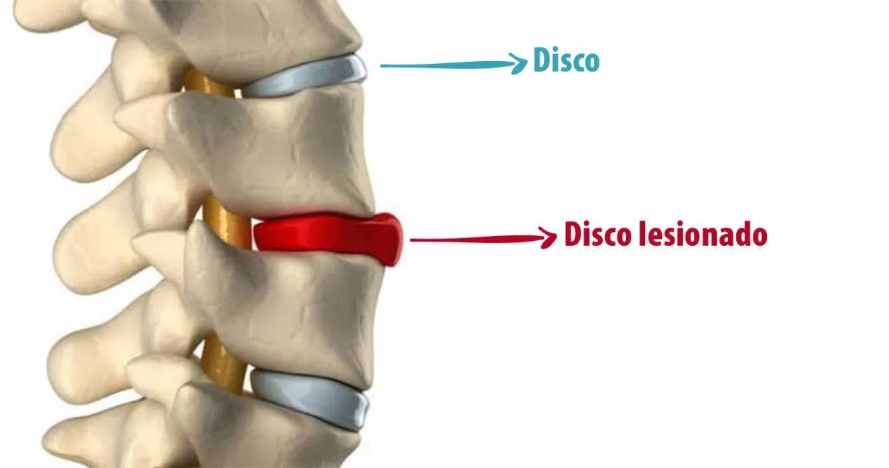 Osteoartrose com discopatia